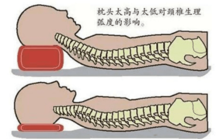 落枕是什麼 落枕是什麼